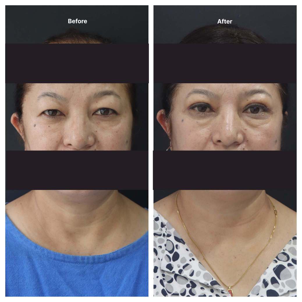 Eyelid Surgery KOQ10